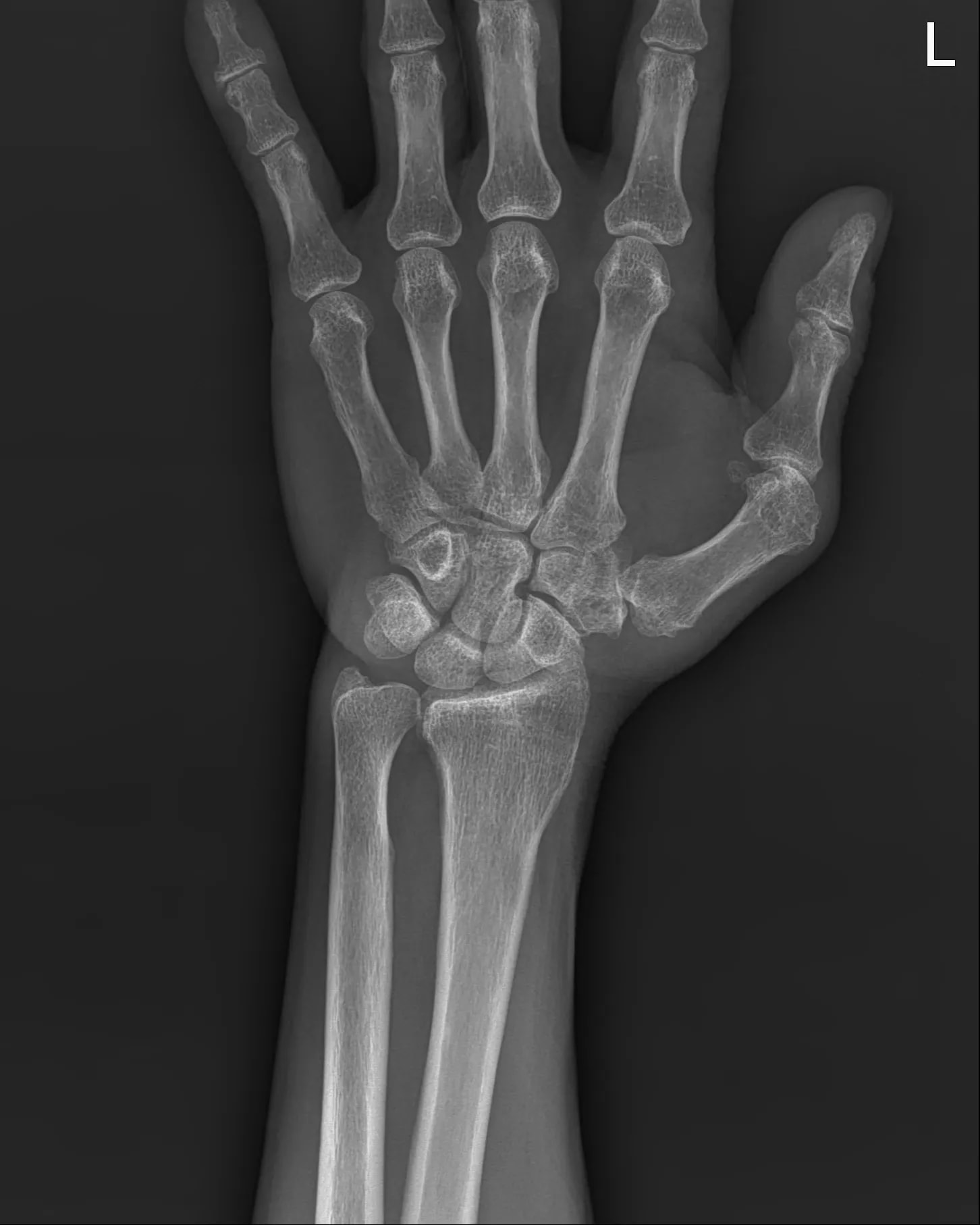 Wrist AP original