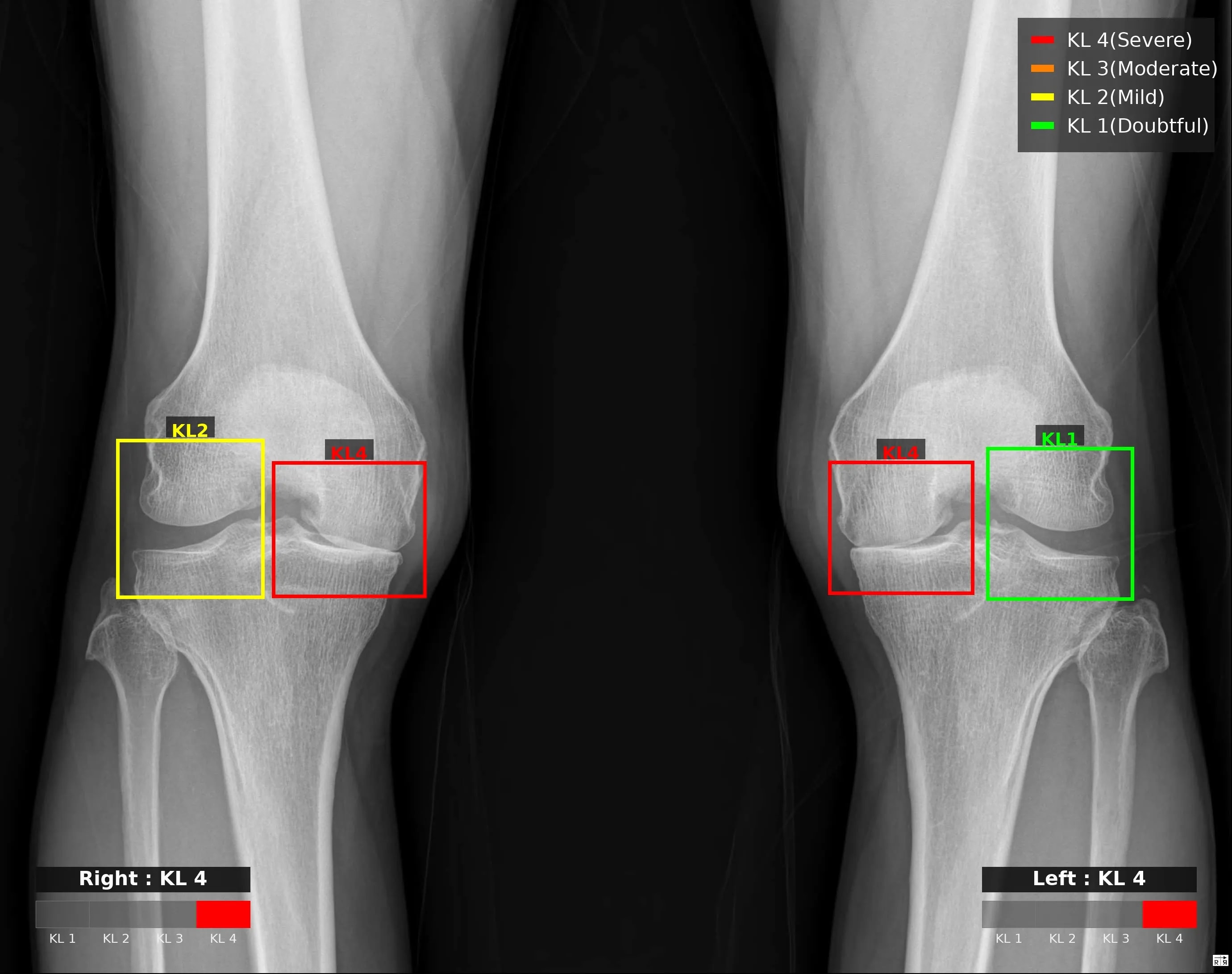 Knee KL result