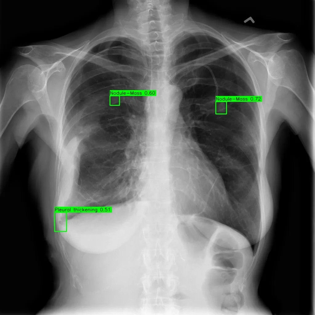 Chest result